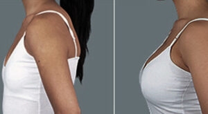 Evolve-Before-After-Breast