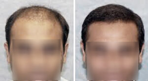 Evolve-Before-After-Hair-Transplant
