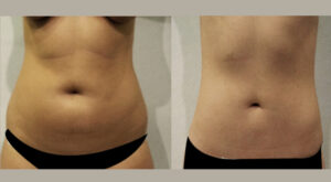 Evolve-Before-After-Liposuction-1