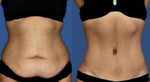 Evolve-Before-After-Tummy-Tuck