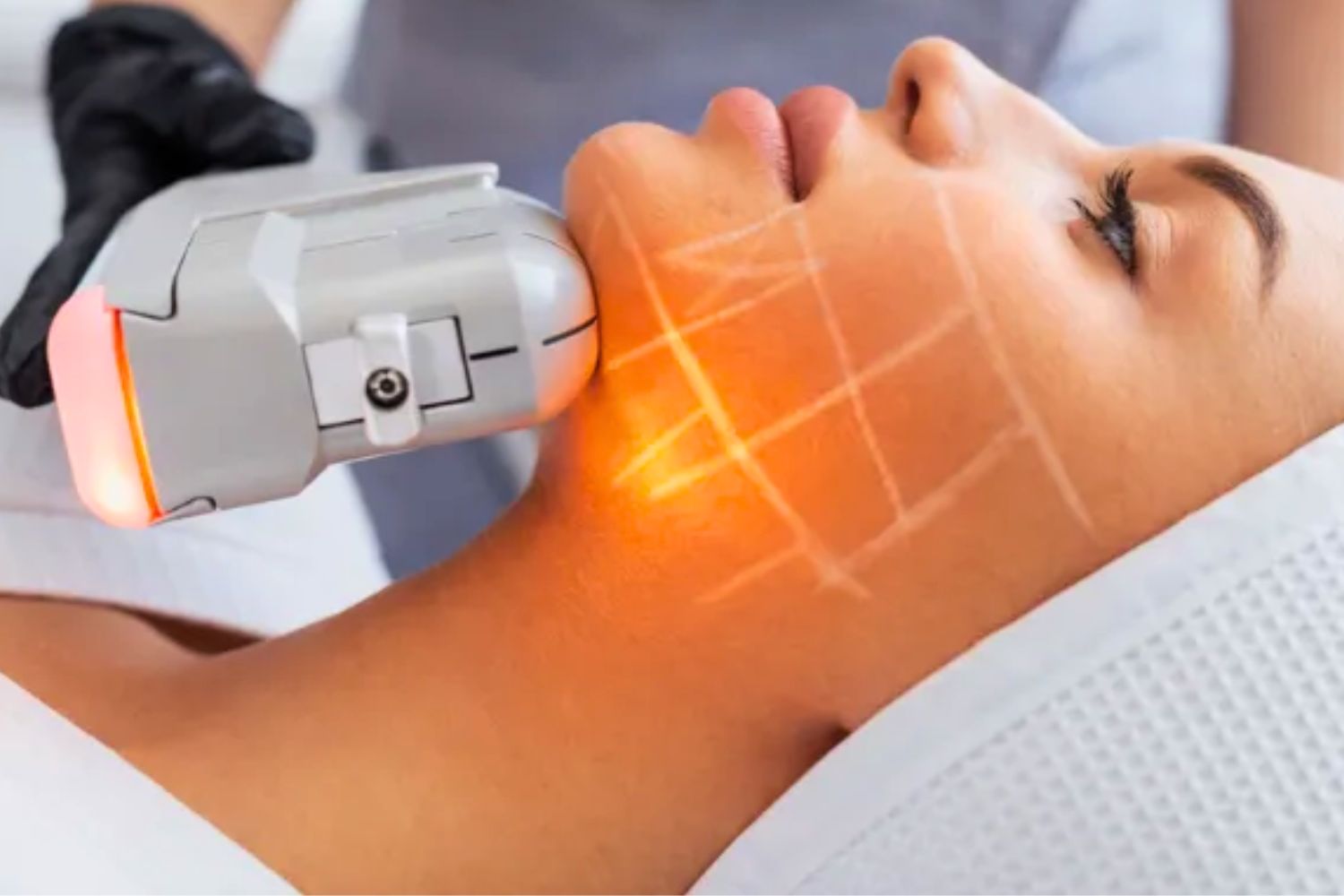 Hifu Skin Tightening 